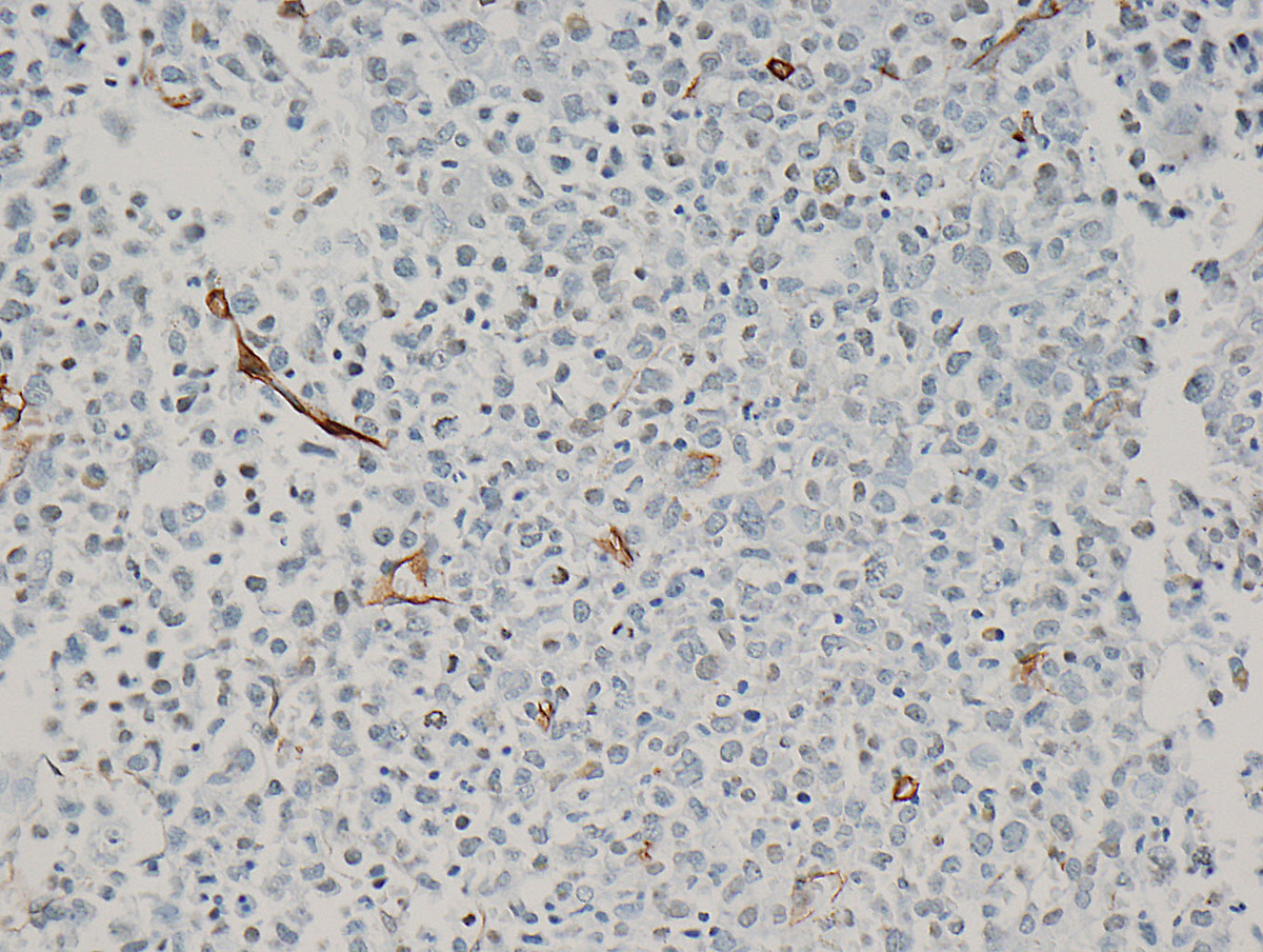 Primitive cells were negative for CD34